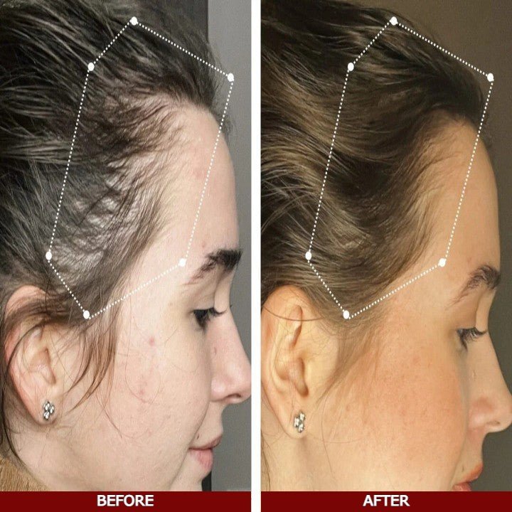 Side-by-side comparison of a woman's hairline before and after treatment, with dotted lines indicating the hairline.