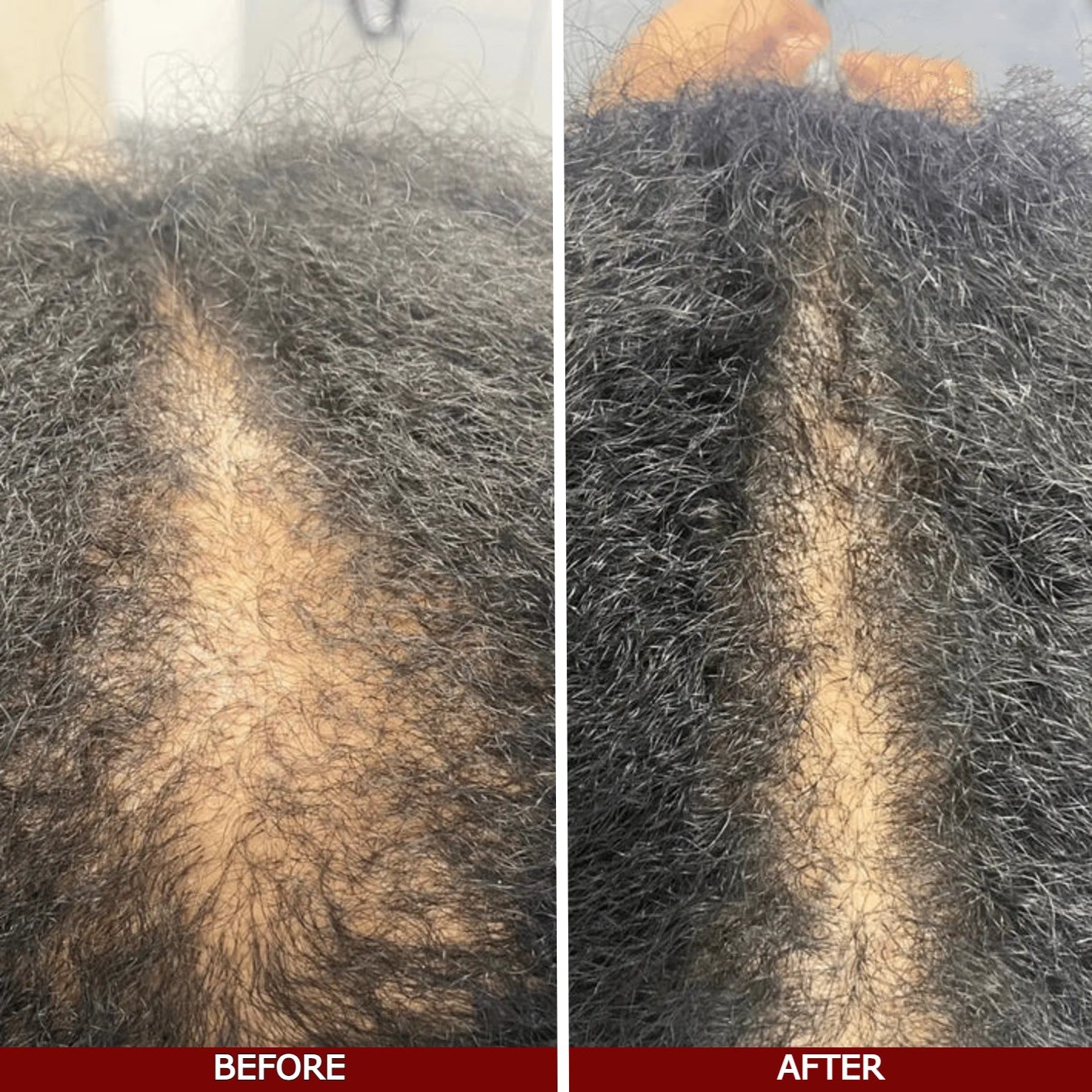 Before and after comparison of hair growth over 3 months.